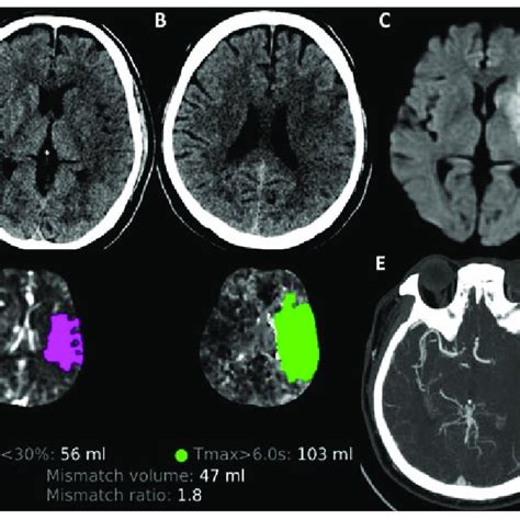 large core stroke trials